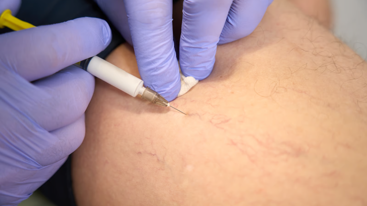 Inyección de escleroterapia en venas superficiales con guía visual