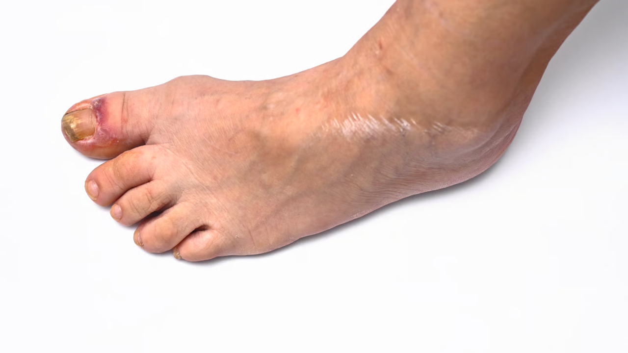 Gangrena en el pie: tipos y causas